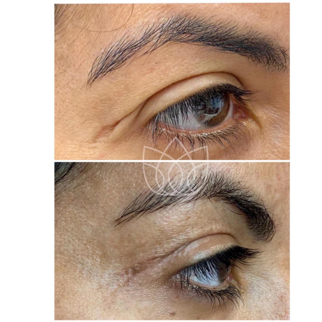 non surgical blepharoplasty