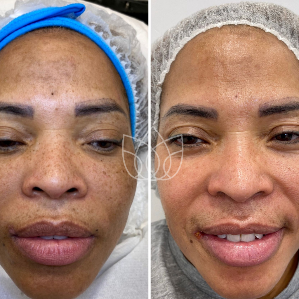 pigmentation treatment