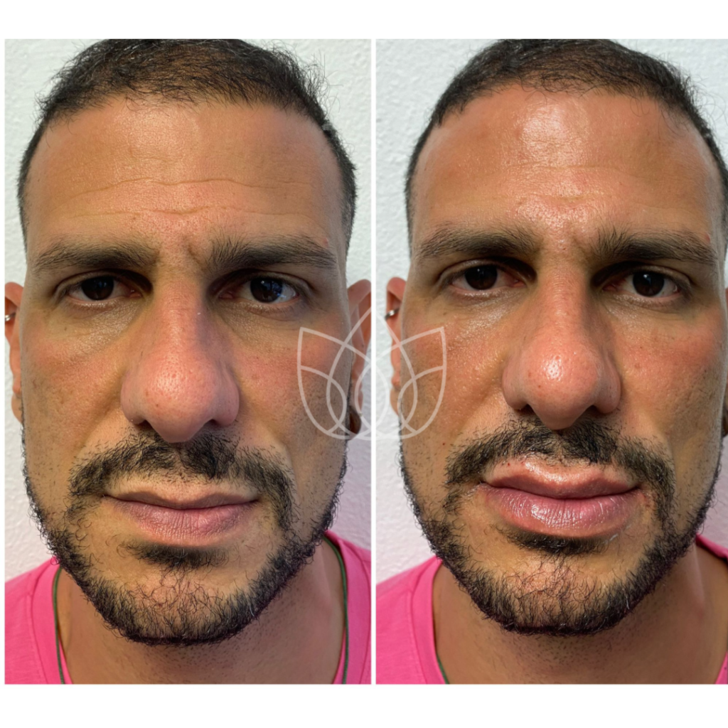 Male Face Rejuvenation