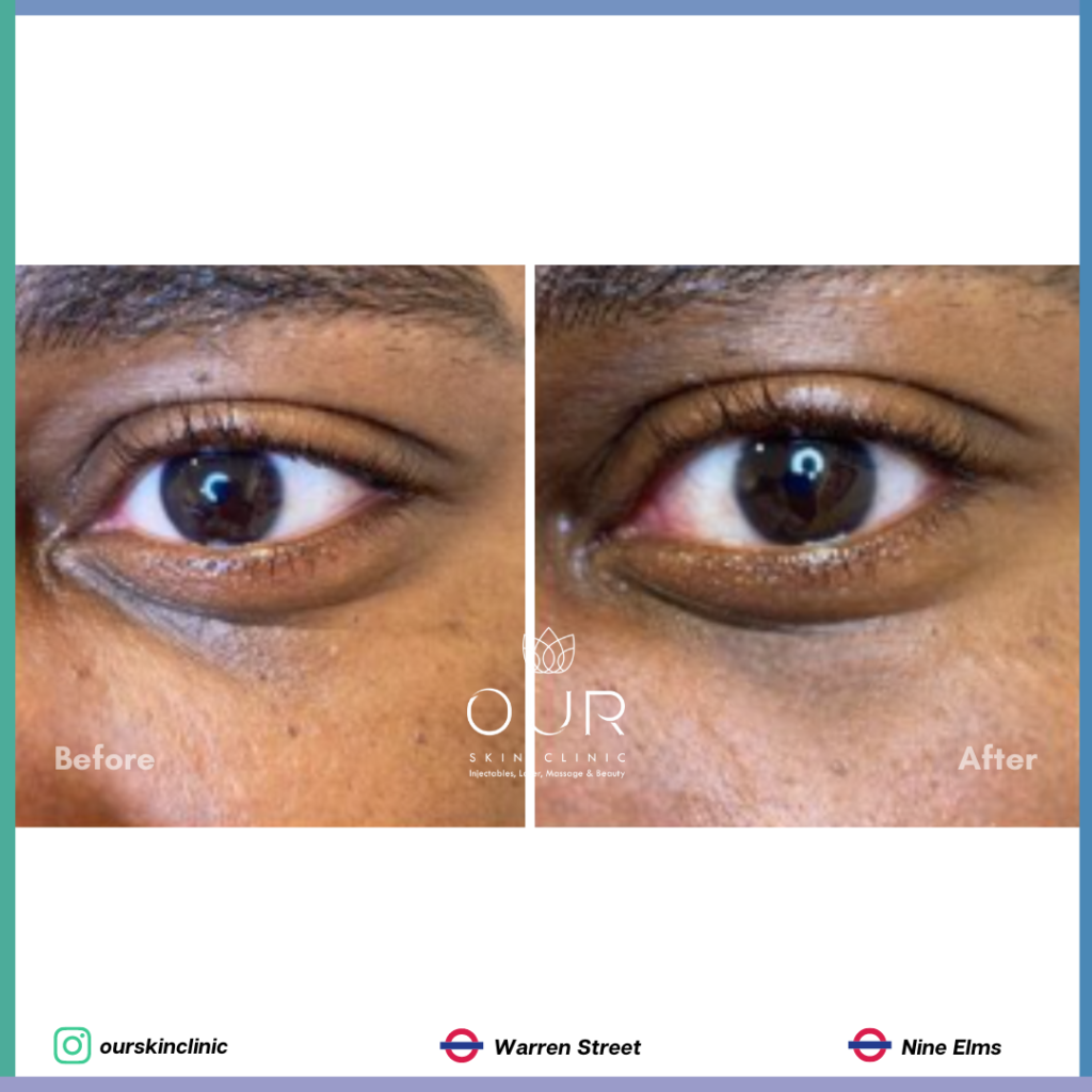 eye-revitaliser-peel-our-skin-clinic-london