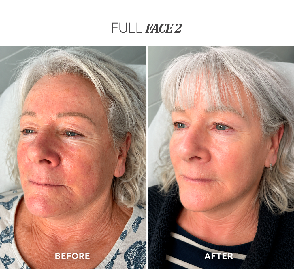 FULL-FACE-TRATMEANT-2